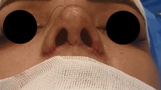 جراحی بینی طبیعی