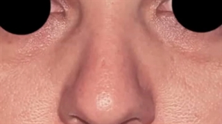 عمل زیبایی بینی در اتاق عمل