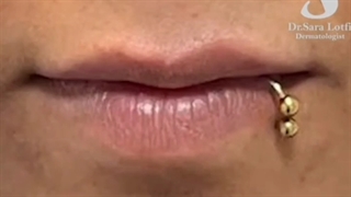 لب خوشفرم میخوای با فیلر؟