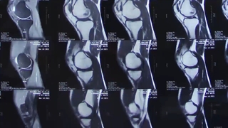 آرتروسکوپی منیسک زانو