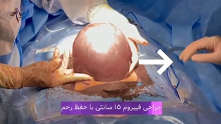 فیبروم به اندازه ۱۵ سانت !!