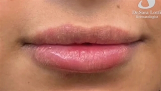 فیلر لب