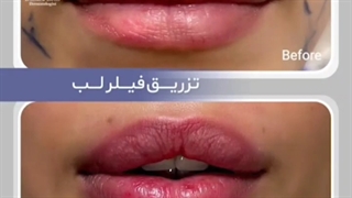 لب برجسته با یک جلسه