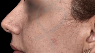 نتیجه جراحی بینی با انحراف شدید