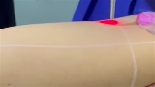 مگه میشه با یه جلسه لیزر مو زائد ...؟؟