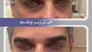 تغییر گودی زیر چشم با یک جلسه