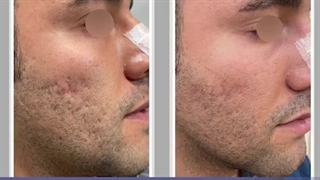 پوست صاف توی یک جلسه