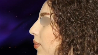 نمونه کار جراخی زیبایی بینی