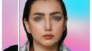 نمونه کار جراحی قبل و بعد بینی