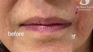 حذف خط خنده