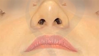 نمونه هایی از جراحی زیبایی بینی