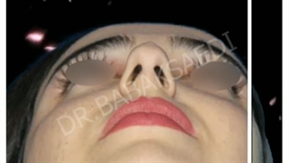 جراحی بینی کــ