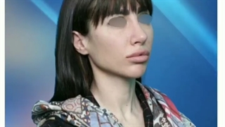 نمونه کار جراحی زیبایی بینی