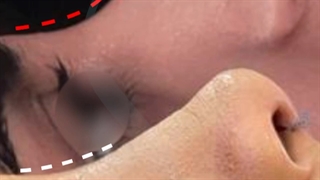 فیلم واقعی نتیجه بعد از جراحی رینوپلاستی