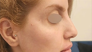 تزریق فیلر گونه