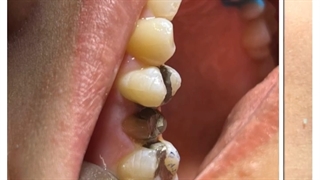 روکش زیرکونیا