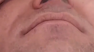 تزریق بوتاکس ترمیم دندان