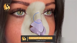 جراحی بینی بسته چجوری انجام میشه؟