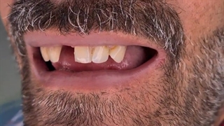 لمینت سرامیکی دندان در اصفهان