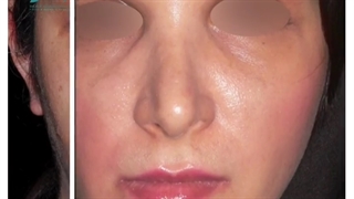 جراحی بینی ترمیمی