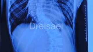 اصلاح کامل اسکولیوز