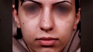 جراحی بینی استخوانی