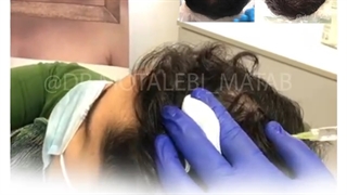 رضایت مراجعه کننده از مزوتراپی مو در کلینیک دکتر مطلبی