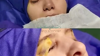 بلافاصله بعد عمل بینی در اتاق عمل ☑️