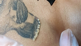 پاک کردن تتو با بهترین دستگاه لیزر