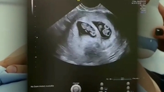 بارداری دوقلویی خانم 44 ساله با IVF و تخمک اهدایی 