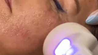 جوانسازی پوست با دستگاه آراف پر کردن دندان