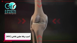 پارگی رباط صلیبی یعنی چی؟