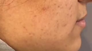 نتیجه درمان جای جوش لیزر صورت