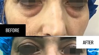 جراحی زیبایی بلفاروپلاستی تحتانی