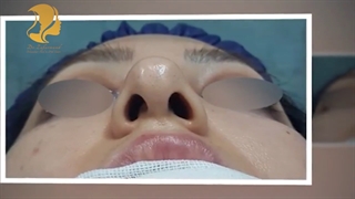 ویدیو جراحی بلافاصله بعد از جراحی بینی