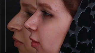 نتیجه رضایت بخش بعد از جراحی رینوپلاستی