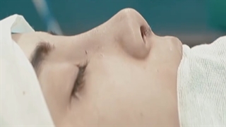 نتیجه بلافاصله بعد از جراحی رینوپلاستی برای مراجعه کننده عزیز