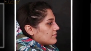 جراحی رینوپلاستی برای مراجعه کننده عزیز