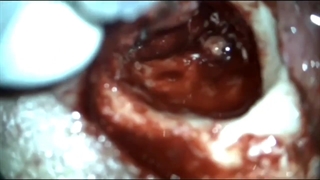 عمل جراحی کلستئاتوم با فیستول مجرای نیم دایره