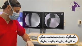 جراحی بیمار جوانی که چند سال قبل دچار شکستگی استخوان گردن ران شدند