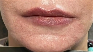 نمونه فیلر چانه
