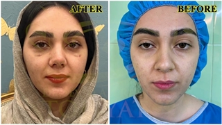 نمونه از جراحی رینوپلاستی بعد از گذشت چند ماه جراحی