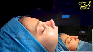 ویدیو بلافاصله بعد از جراحی رینوپلاستی