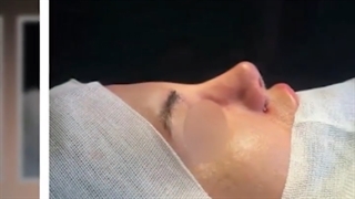 نمونه ای از جراحی رینوپلاستی با فرم طبیعی