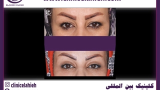 جراحی پلک