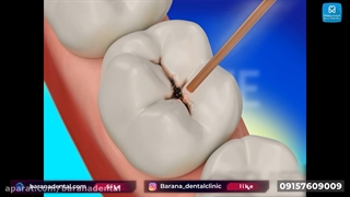 از بین بردن پوسیدگی دندان با لیزر برداشتن خال گوشتی