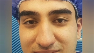 جراحی بینی گوشتی