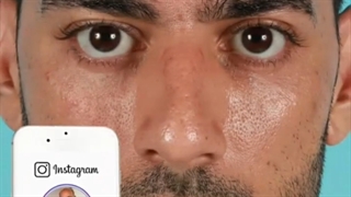 نتیجه جراحی بینی