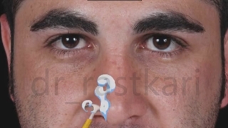 عمل بینی مردانه