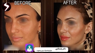 قبل و بعد جراحی بینی